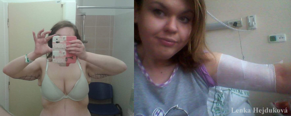 Na plastice pa�� v �noru 2014